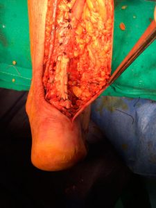 Reparacion-del-tendon-de-aqules-con-cirugia-abierta