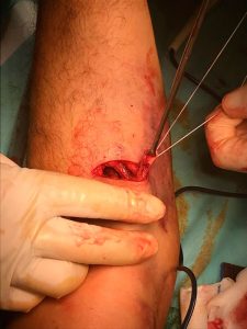 Rotura-biceps-distal Traumatologia y Cirugia de Miembro superior