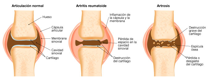 artrosis-y-condroprotectores tratamiento con cartilat complex